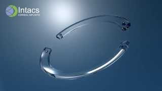 INTACS Corneal Implants [upl. by Chu]