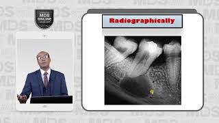 4 3 Radicular Cyst Rediographically [upl. by Sorodoeht]