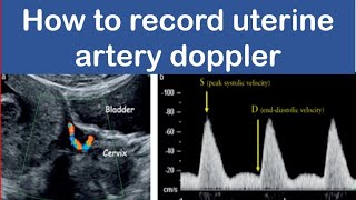 How to record uterine artery doppler [upl. by Hgielah]