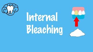 Internal Bleaching [upl. by Imeaj]