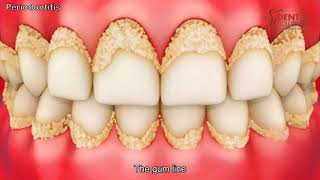 Periodontitis – Causes Symptoms Risk Factors 3d dental animation [upl. by Gnaoh419]