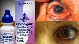 Combigan Eye Drop For Ocular Hypertension glaucoma  Brimonidine  Timolo [upl. by Drabeck]