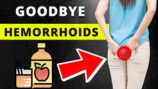 7 Home Remedies to Get Rid of Hemorrhoids and Prevent Them [upl. by Avra]