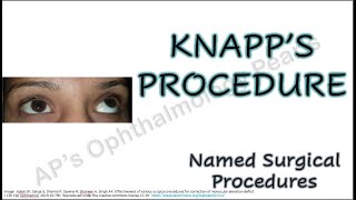 Knapp’s procedure  Named Surgical Procedures [upl. by Daisy]