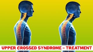 Upper Crossed Syndrome  Treatment [upl. by Adok]