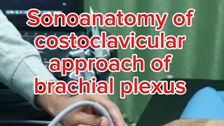 Sonoanatomy of costoclavicular approach of the brachial plexus [upl. by Darryn]