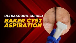 👨‍⚕️ UltrasoundGuided Baker Cyst Aspiration A video demonstration [upl. by Dyoll]