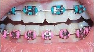 MY BRACES 101 updatessss [upl. by Pieter]