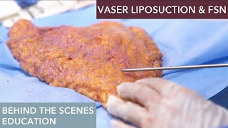 How does Vaser Liposuction work [upl. by Oicam265]