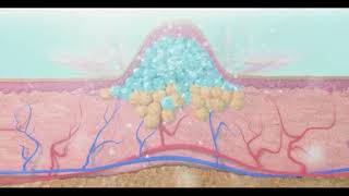 Cryolipolyse Cooltech [upl. by Ledah]