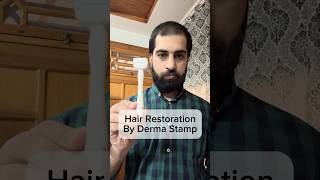 Hair Restoration using Derma Stamp hairlosstreatment regrowhairline [upl. by Tap65]