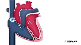 Sistema eléctrico del corazón  Animación médica [upl. by Iat]