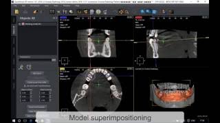 QuickVision 3D Superimpositioning OWANDY RADIOLOGY [upl. by Ahsinnod]