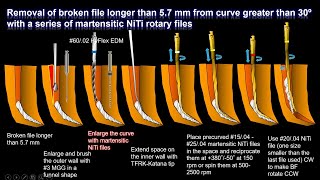 New removal technique for broken files longer than 57 mm57 mm以上の破折器具除去の新たなテクニック [upl. by Riki]