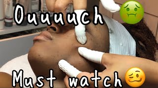 Facial Black Head Extraction ‼️‼️ [upl. by Nila841]