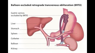 Balloon Occluded Retrograde Transvenous Obliteration Surgical procedure  Definition Advantages [upl. by Dola]