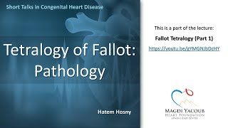 Tetralogy of Fallot  Pathology  Hatem Hosny [upl. by Dleifyar]