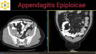 Appendagitis Epiploicae [upl. by Cleaves97]