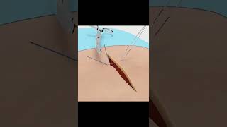 Sutures and Suturing techniques surgeryshortsanatomy [upl. by Perkin124]