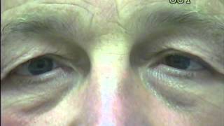 Nystagmus eye movement recording 2 [upl. by Yerffoj]