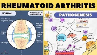 Rheumatoid Arthritis Pathophysiology  Rheumatoid Arthritis Pathogenesis  Arthritis pathophysiology [upl. by Anett450]