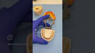 Amelogenesis imperfecta dentist viralreels teeth bestdentist viralvideo viral implant [upl. by Jerad]