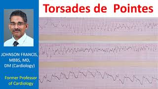 Torsades de Pointes [upl. by Brnaba626]