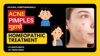 मुहासे  Acne  PIMPLES  Best Homeopathic Treatment  Dr Aadil Chimthanawala  Skin Complaints [upl. by Regdirb]