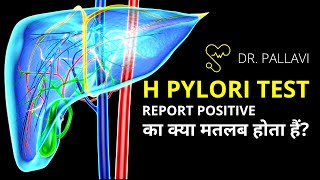 H Pylori Positive Report Meaning and Symptoms  Helicobacter Pylori Test Report Explained [upl. by Critta]