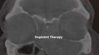 Dupixent Therapy Before amp After  ENT New Orleans Metairie Chalmette  GNO Snoring amp Sinus [upl. by Anaeco]