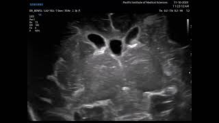 Germinal matrix hemorrhages on ultrasound [upl. by Adihsar]