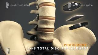 Lumbar TDR – Lumbar Spine Surgery [upl. by Sanders914]