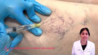 Sclerotherapy Varicose and Spider Vein Treatment  Dr Shalini Gupta [upl. by Carlie]