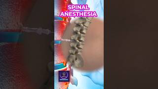 Spinal Anesthesia injection 💉 shorts [upl. by Ahsiled]