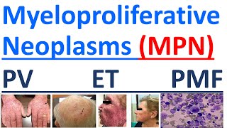 Myeloproliferative Neoplasms explained [upl. by Aicela]