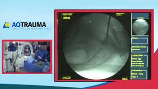 Percutaneous insertion of S1 iliosacral screw Mr Anthony Ward [upl. by Nosnevets]