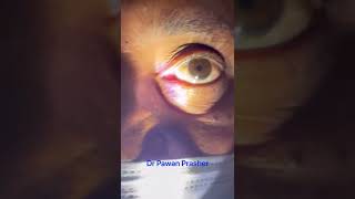 RAPD Relative Afferent Pupillary Defect [upl. by Vadim]