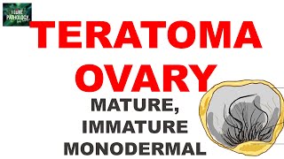 TERATOMAOVARY Ovarian Tumor Series Part 5 [upl. by Adrahc]