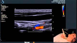 Hot Tips  Finding the Vertebral Artery with Ultrasound [upl. by Purpura]