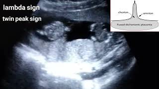 Dichorionic diamniotic twin pregnancylambda sign [upl. by Collin654]