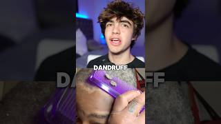 How to get rid of dandruff 😱🤝 [upl. by Eniksre]