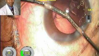 Presbyopic Lens Exchange PRELEX amp AMO Tecnis One Piece Multifocal IOL Implantation [upl. by Lime298]