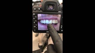 Correcting Crooked Teeth With Composite Bonding BeforeAfter [upl. by Binetta]