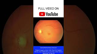 Central Retinal Artery Occlusion Fundoscopy shorts [upl. by Augustine]