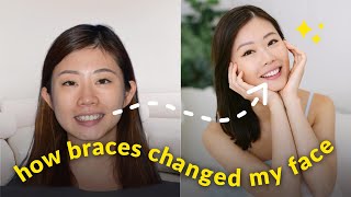 How Braces Changed My Face in 1 Year  My Invisalign Journey [upl. by Balthasar265]