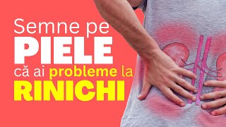 8 semne pe piele că ai probleme la RINICHI [upl. by Jerrilee]