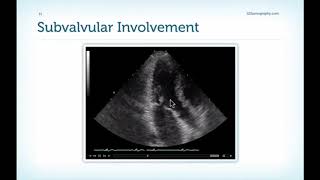 Masterclass lecture 114 Mitral stenosis Valvuloplasty [upl. by Naujik]