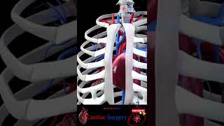 Open Heart Cardiac Surgery  animationshorts shortsfeed youtubeshorts viralshorts [upl. by Odawa367]