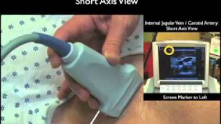 How To Ultrasound Guidance for Central Venous Access Part 1 Case Study [upl. by Elrak]