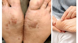 homemade Foot care tips Dry cracked Heel Care routine for instant Soft smooth Feet [upl. by Morocco]